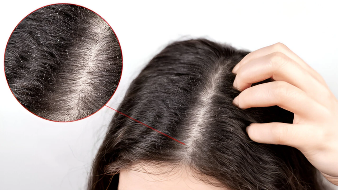Do Lice Like Dirty Hair? Debunking Myths and Facts