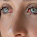 Is It Pink Eye or Allergies? Learn to Spot the Difference