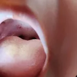 Red Spots on Roof of Mouth: Causes And What to Do Red Spots on Roof of Mouth: Causes And What to Do