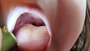 Red Spots on Roof of Mouth: Causes And What to Do