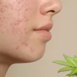 Does Smoking Marijuana Cause Acne? Let’s Clear the Air Does Smoking Marijuana Cause Acne? Let’s Clear the Air
