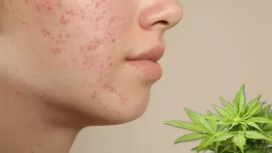 Does Smoking Marijuana Cause Acne? Let’s Clear the Air