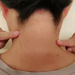 What Causes a Lump on the Back of Your Neck Hairline?