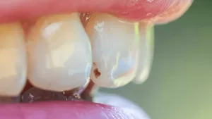 What To Do About Brown Spots On Your Teeth