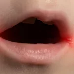 How to Get Instant Relief from Burning Mouth Syndrome