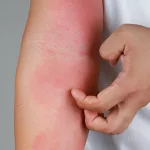 Can Castor Oil Really Help with Eczema? Here’s What You Need to Know