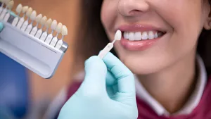 Everything You Need to Know About Dental Veneers