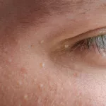 Causes and Removal of Eyelid Skin Tags: Your Guide Causes and Removal of Eyelid Skin Tags: Your Guide