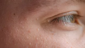 Causes and Removal of Eyelid Skin Tags: Your Guide Causes and Removal of Eyelid Skin Tags: Your Guide