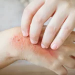 Fleabites 101: What They Look Like & How to Deal Fleabites 101: What They Look Like & How to Deal