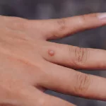 18 Best Home Remedies for Warts: Safe and Effective?