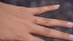 18 Best Home Remedies for Warts: Safe and Effective?
