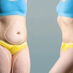 Liposuction: Benefits, Risks, and What You Need to Know