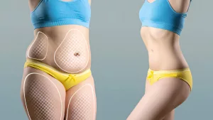 Liposuction: Benefits, Risks, and What You Need to Know Liposuction: Benefits, Risks, and What You Need to Know