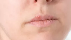 Understanding Bumps on the Lip: Causes, Treatments, and More