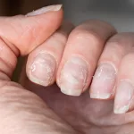10 Nail Diseases: What They Look Like and How to Treat Them 10 Nail Diseases: What They Look Like and How to Treat Them