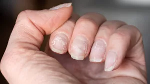10 Nail Diseases: What They Look Like and How to Treat Them