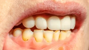 Plaque vs. Tartar: Key Differences You Need