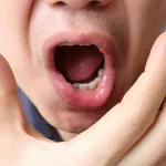 Why Does the Roof of My Mouth Hurt? Causes and Fixes