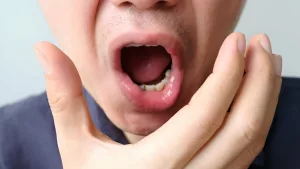 Why Does the Roof of My Mouth Hurt? Causes and Fixes