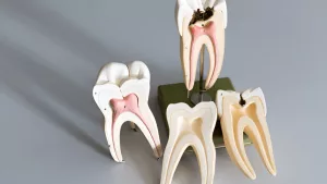 Root Canal Recovery Time: How to Heal Fast
