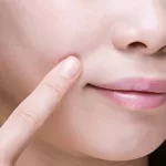 How to Get Rid of Laugh Lines With Exercises Naturally How to Get Rid of Laugh Lines With Exercises Naturally