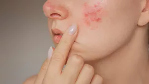 Sulfur For Acne: How To Use And Benefits