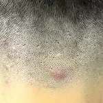 Life-Changing Acne Keloidalis Nuchae Surgery Now