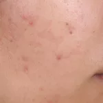 Before and After Acne: Break Free From Breakouts Before and After Acne: Break Free From Breakouts