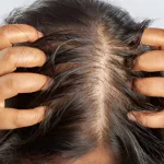 Best Shampoos for Itchy Scalp and Hair Loss: Quick Solutions Best Shampoos for Itchy Scalp and Hair Loss: Quick Solutions