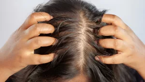 Best Shampoos for Itchy Scalp and Hair Loss: Quick Solutions