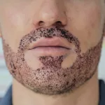 Beard Implants: Your Path to a Bold, Full Beard Beard Implants: Your Path to a Bold, Full Beard