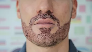 Beard Implants: Your Path to a Bold, Full Beard Beard Implants: Your Path to a Bold, Full Beard