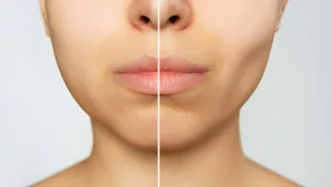 Buccal Fat Removal: Worth the Price for Slimmer Cheeks? Buccal Fat Removal: Worth the Price for Slimmer Cheeks?