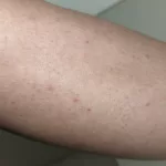 Oh No! Bumps After Waxing? Here’s How to Fix Them Fast Oh No! Bumps After Waxing? Here’s How to Fix Them Fast