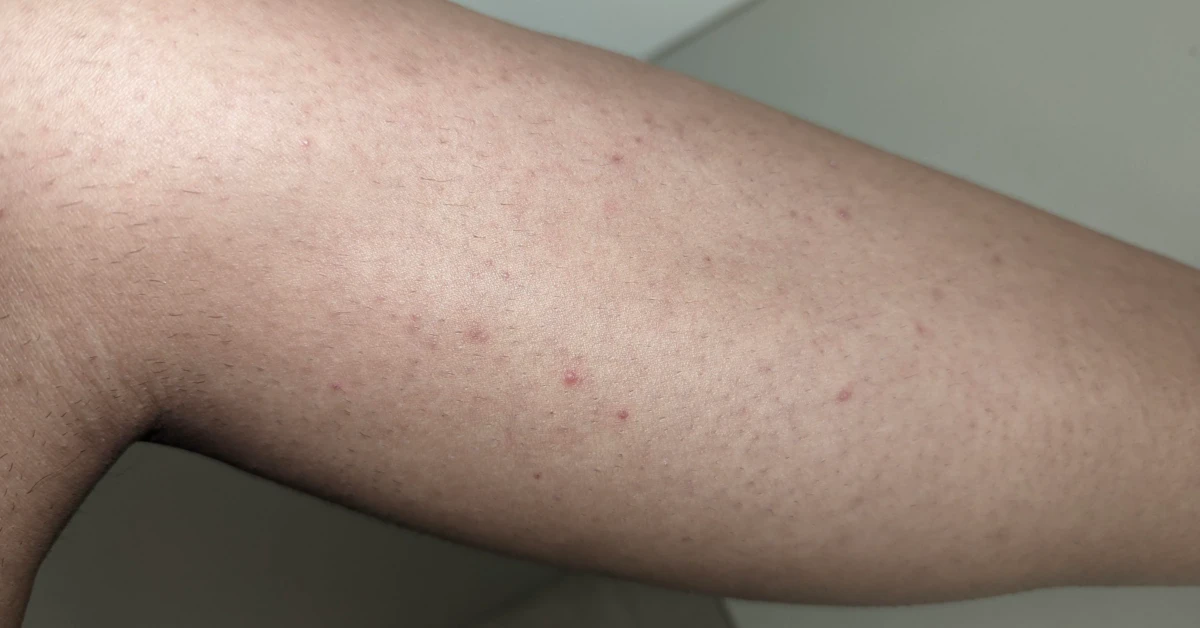 Oh No! Bumps After Waxing? Here’s How to Fix Them Fast