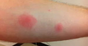 Can Roaches Bite You in Your Sleep? The Surprising Truth