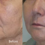 CO2 Laser Resurfacing Cost: Is It Suitable for Your Skin?