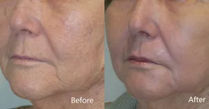 CO2 Laser Resurfacing Cost: Is It Suitable for Your Skin?