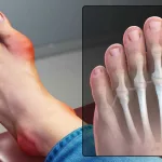 Can You Really Get Disability for Gout? Honest, Human Guide Can You Really Get Disability for Gout? Honest, Human Guide