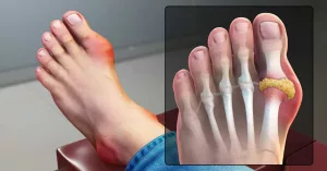 Can You Really Get Disability for Gout? Honest, Human Guide Can You Really Get Disability for Gout? Honest, Human Guide