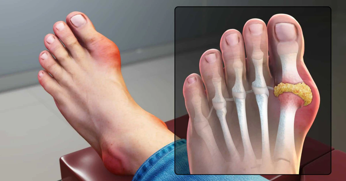 Can You Really Get Disability for Gout? Honest, Human Guide