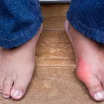 Does Gout Qualify for Disability? Answers & Real Advice