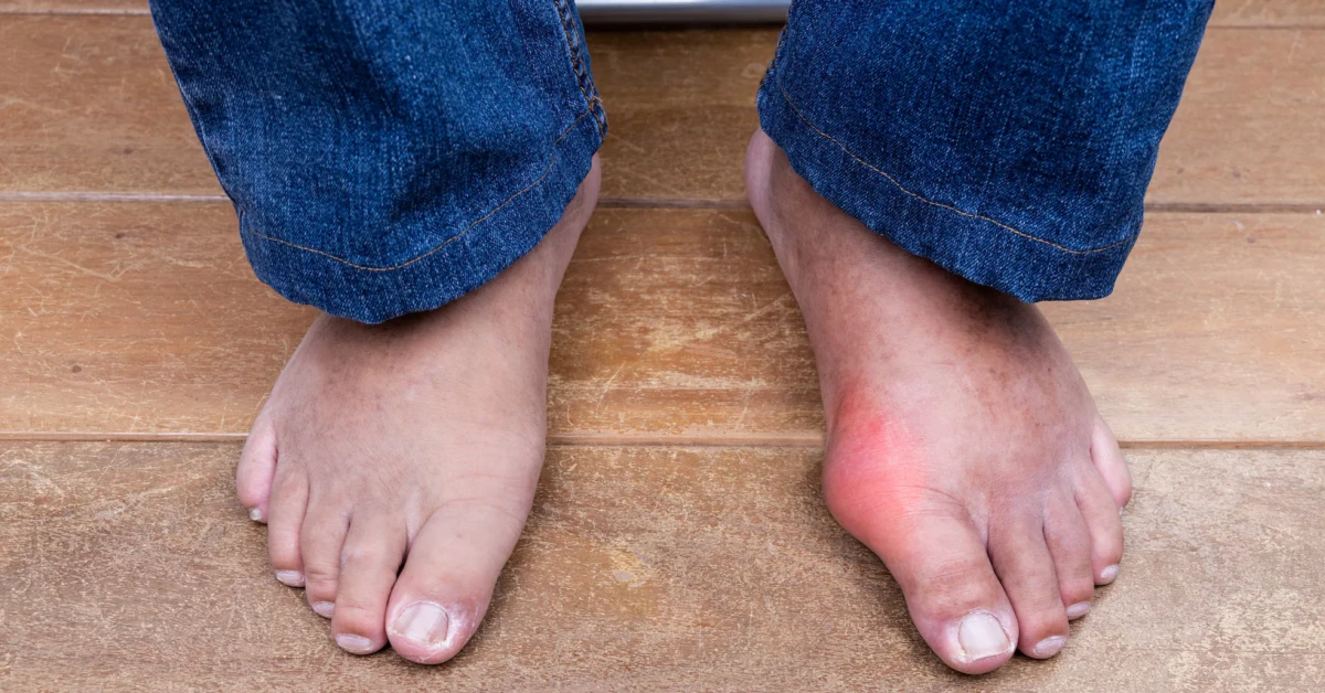 Does Gout Qualify for Disability? Answers & Real Advice