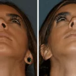 Balloon Sinuplasty Before and After: See Results! Balloon Sinuplasty Before and After: See Results!