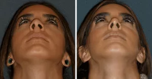 Balloon Sinuplasty Before and After: See Results! Balloon Sinuplasty Before and After: See Results!