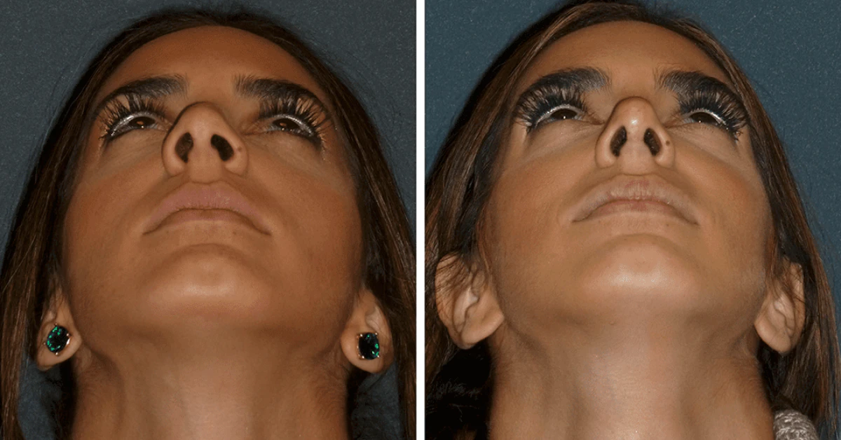 Balloon Sinuplasty Before and After: See Results!