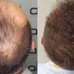 Beard to Head Transplant: See Real Results!