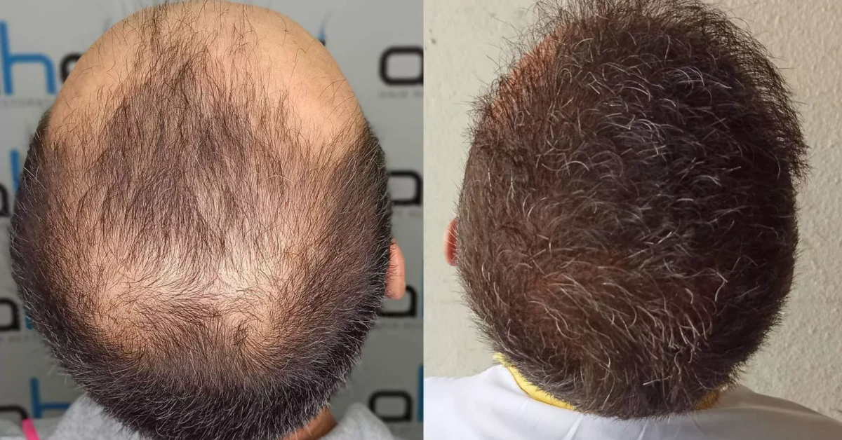 Beard to Head Transplant: See Real Results!