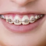 Best Braces for Teens: Straight Talk on Smiles & Confidence Best Braces for Teens: Straight Talk on Smiles & Confidence